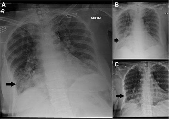 This composite diagnostic image features three panels (A, B, and C) of anterior-posterior (AP) chest radiographs documenting the progression and treatment response of a patient with acute fibrinous and organizing pneumonia (AFOP). Panel A (presentation) reveals bilateral lower zone pathologies, characterized by inhomogeneous opacification and soft tissue infiltrates in the right basal lung (black arrow) and haziness in the left lower zone, with blunting of both costophrenic angles. Panel B, taken after one week of antibiotic therapy, demonstrates an interval increase in homogenous haze and airspace shadowing in the right lower lung zone, indicating a lack of response to antimicrobial treatment. Panel C, following one week of corticosteroid therapy, shows significant interval resolution of the right lower lobe opacities and improved lung aeration. The series illustrates the hallmark radiographic feature of AFOP: persistent or worsening opacities despite antibiotics that show rapid dramatic resolution upon administration of steroids. The imaging highlights the importance of distinguishing organizing pneumonia patterns from infectious processes in clinical practice.