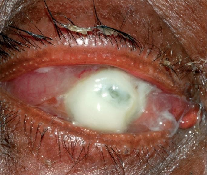 Clinical photograph of a human eye demonstrating severe infective keratitis (bacterial corneal ulcer), specifically consistent with a Pseudomonas aeruginosa infection. The primary feature is a large, dense, whitish-yellow suppurative infiltrate occupying most of the cornea. The infiltrate appears necrotic and liquefactive, typical of rapid enzymatic corneal destruction. The surrounding bulbar conjunctiva shows intense ciliary injection and diffuse hyperemia. Thick, mucopurulent discharge is visible along the eyelid margins and within the conjunctival fornices. The eyelids exhibit significant erythema and edema. This visual representation highlights the clinical signs of a sight-threatening ocular emergency, where the loss of corneal structural integrity puts the eye at high risk for imminent perforation. It serves as a classic educational example of suppurative microbial keratitis for ophthalmology and emergency medicine training.