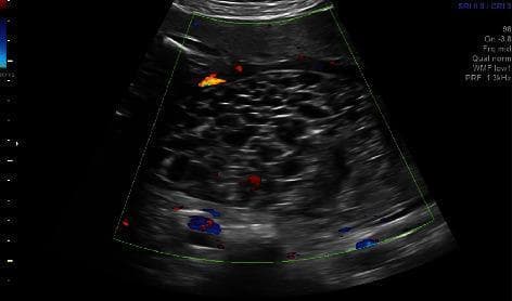 Diagnostic ultrasound image featuring a color Doppler study of a molar placenta, characteristic of a complete hydatidiform mole. The grayscale background reveals a heterogeneous, multicystic placental mass often referred to as a 'snowstorm' or 'swiss cheese' pattern. This is comprised of numerous small, anechoic vesicular structures representing hydropic villi. Superimposed color Doppler signals (red and blue) demonstrate active blood flow within the septations and around the cystic spaces, indicating significant vascularity of the molar tissue. This imaging modality is essential for distinguishing gestational trophoblastic disease from other uterine masses, such as degenerating fibroids or chorioangiomas. The clinical context involves a rare case of a twin pregnancy with a coexisting complete hydatidiform mole, where the diagnostic focus is on the distinct morphology of the abnormal third placental mass and its associated high vascularity.