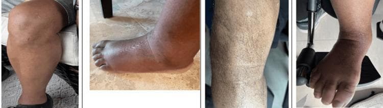 Clinical photograph sequence illustrating the temporal progression of dermatological and vascular symptoms in a patient with POEMS syndrome. The composite consists of four images captured over a ten-month period. The first image (January) shows a baseline lower extremity with normal skin texture and hair distribution. The second image (February) demonstrates significant non-pitting dependent edema involving the foot and ankle, obscuring typical anatomical contours. The final two images (October) showcase late-stage manifestations including diffuse hypertrichosis (abnormal increase in hair growth) and prominent cutaneous hyperpigmentation across the lower leg. The fourth panel reveals a reduction in edema, consistent with clinical management through limb elevation and the use of compression/support hosiery. These visual markers—polyneuropathy, organomegaly, endocrinopathy, monoclonal protein, and skin changes—serve as key diagnostic indicators for multisystem plasma cell dyscrasias.