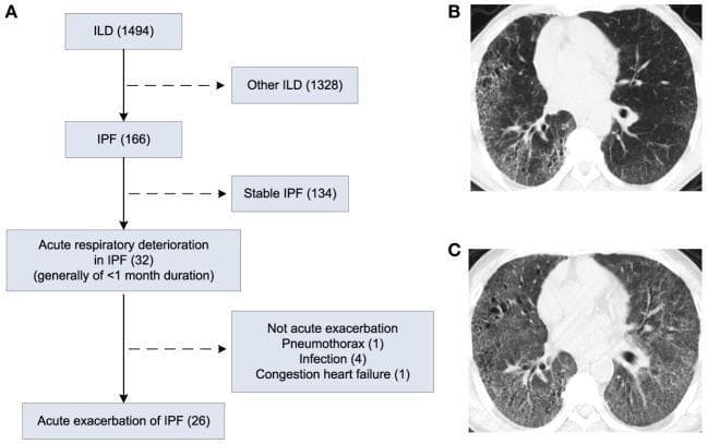 This composite educational image includes a clinical flowchart and two high-resolution computed tomography (HRCT) axial slices of the chest, illustrating the progression from stable Idiopathic Pulmonary Fibrosis (IPF) to an Acute Exacerbation (AE-IPF). Panel A presents a study flowchart detailing the selection process of 26 patients with AE-IPF from a cohort of 1,494 patients with interstitial lung disease (ILD). Panel B displays an axial HRCT scan showing classic features of Usual Interstitial Pneumonia (UIP) associated with stable IPF, including peripheral-predominant reticular opacities, traction bronchiectasis, and subpleural honeycombing. Panel C shows the same patient during an acute exacerbation. In addition to the pre-existing fibrotic changes seen in Panel B, there is now diffuse, bilateral ground-glass opacities (GGO), representing the hallmark radiological sign of acute alveolar damage superimposed on chronic fibrosis. This comparison highlights the key diagnostic imaging criteria for AE-IPF, essential for pulmonology and radiology education.