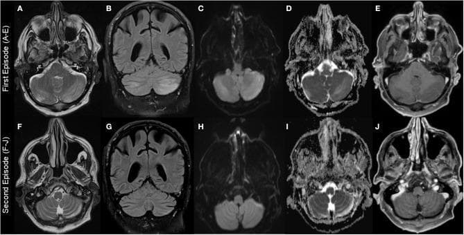 This Comparison Chart displays a panel of axial and coronal brain MRI scans from two distinct clinical episodes (First Episode A-E; Second Episode F-J) in a patient with Hypomagnesemia-induced Cerebellar Syndrome (HiCS). The first episode images demonstrate prominent, left-dominant hyperintense signals in the cerebellar hemispheres on T2-weighted (A), FLAIR (B), and DWI (C) sequences. The ADC map (D) also shows hyperintensity, suggesting vasogenic edema rather than cytotoxic edema. Corresponding T1-weighted images with gadolinium (E) show hypointense lesions without contrast enhancement. In the second episode, follow-up imaging (F-J) reveals a significant reduction in the size and signal intensity of the cerebellar abnormalities. While residual hyperintensity persists on T2W (F), FLAIR (G), and ADC (I), the DWI sequence (H) has normalized. These findings illustrate the characteristic reversible or partially reversible cerebellar edema associated with profound magnesium deficiency, which can mimic subacute stroke or cerebellitis but typically lacks contrast enhancement and restricted diffusion.