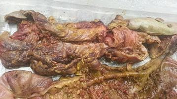 This clinical photograph shows a gross pathological total colectomy specimen from a patient with Familial Adenomatous Polyposis (FAP). The resected colon is opened longitudinally to reveal the mucosal surface. The image displays the caecum and ascending colon in the lower section, with the descending colon positioned above. The most prominent feature is the extensive, dense distribution of hundreds of adenomatous polyps across the mucosal lining, creating a characteristic 'carpeted' appearance. Centrally located in the upper portion of the specimen is a visible surgical site corresponding to a previous anastomosis. The tissue appears erythematous and fleshy, typical of a fresh surgical specimen. This image serves as a classic educational example of the phenotypic manifestation of FAP, illustrating the necessity of radical surgical intervention due to the high density of precancerous lesions throughout the colorectal tract.