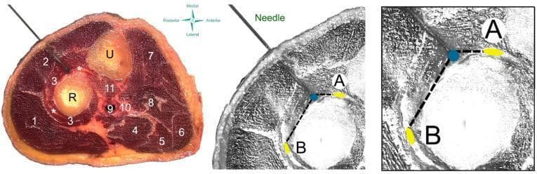 This composite educational resource illustrates a dry needling procedure targeting the supinator muscle of the forearm. The left panel shows a cadaveric cross-section of the proximal forearm with numerical labels identifying key anatomical structures: radius (R), ulna (U), brachioradialis (1), wrist extensors (2), supinator muscle (3), and various flexor compartment muscles (4–8). A needle is shown penetrating the dorsal aspect, passing through the wrist extensors into the supinator muscle belly near the radial nerve branches (*). The center and right panels provide anatomical diagrams focused on the safety profile of the procedure. They map the spatial relationship between the needle tip (blue dot) and critical neurovascular structures: the deep branch (A) and the superficial branch (B) of the radial nerve. Dashed lines represent measurement distances from the needle tip to these nerve branches, serving as a clinical guide for procedural accuracy and hazard avoidance. This material is designed for advanced musculoskeletal anatomy education and clinical training in physical therapy or sports medicine.