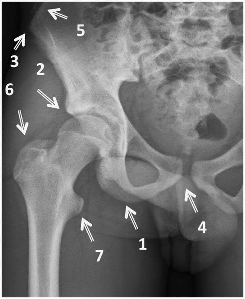 This diagnostic image is an anteroposterior (AP) radiograph of the right hip and pelvis, annotated to demonstrate common sites for avulsion fractures. The radiograph shows the bony anatomy of the pelvis, including the ilium, ischium, and pubis, along with the proximal femur. Seven specific anatomical landmarks where tendons or muscles attach are highlighted with arrows and numbers: (1) Ischial tuberosity (hamstrings), (2) Anterior inferior iliac spine (rectus femoris), (3) Anterior superior iliac spine (sartorius/tensor fasciae latae), (4) Pubic symphysis (adductors/gracilis), (5) Iliac crest (abdominal muscles), (6) Greater trochanter (gluteal muscles), and (7) Lesser trochanter (iliopsoas). The image serves as an educational diagram for sports medicine and orthopedics, illustrating the pathophysiology of traction-related injuries where forceful muscle contraction pulls off a bone fragment at its insertion point. It is intended for medical students and clinicians to aid in the identification of diagnostic hotspots in pelvic trauma cases.