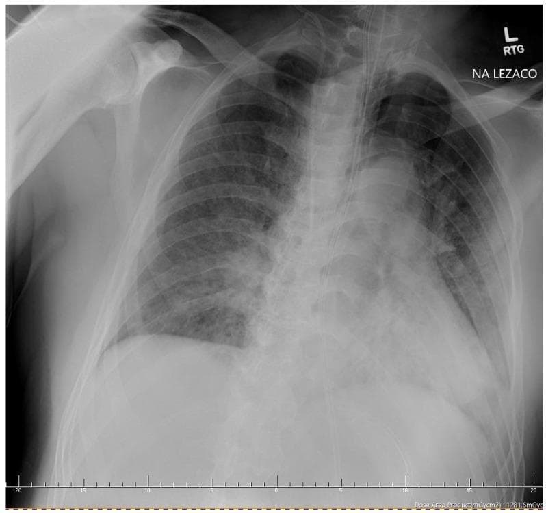 This diagnostic image is an anteroposterior (AP) chest X-ray of an adult patient, demonstrating severe acute respiratory pathology. The image reveals diffuse, bilateral interstitial and alveolar opacities, consistent with ground-glass opacities seen in severe viral pneumonia (e.g., COVID-19). These opacities are most dense in the lower lung zones, causing obscuration of the diaphragmatic borders. A prominent left-sided pneumothorax is visible, characterized by a thin, white visceral pleural line separated from the lateral chest wall by a hyperlucent peripheral space devoid of lung markings. This indicates significant pleural air accumulation. Additionally, signs of subcutaneous emphysema are present in the soft tissues of the left chest wall and neck. The image also depicts clinical monitoring and support equipment, including a central venous catheter and an endotracheal tube, suggesting an intensive care setting. The primary educational focus is the identification of secondary complications, such as barotrauma or spontaneous pneumothorax, in the context of severe diffuse interstitial lung disease.