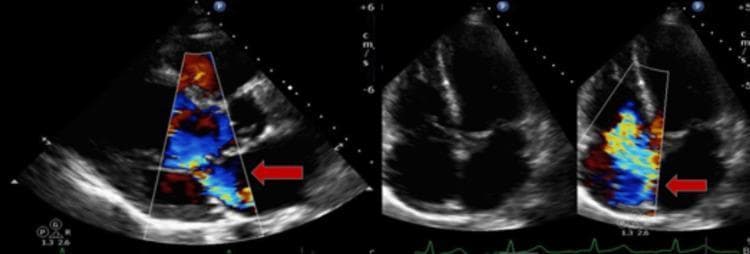 Transthoracic echocardiogram (TTE) images demonstrating valvular regurgitation using color Doppler. The image on the left shows a parasternal long-axis view (PLAX) focusing on the mitral valve. A moderate mitral regurgitation (MR) jet is identified by a red arrow, appearing as a turbulent, multicolored (blue and yellow) conical flow originating from the mitral leaflets and extending into the left atrium during systole. The images on the right side show an apical four-chamber view without and with color Doppler. The color Doppler frame on the far right highlights tricuspid regurgitation (TR), indicated by a red arrow. The TR jet exhibits significant mosaicism, suggesting moderate to severe severity as the turbulent flow occupies a substantial portion of the right atrial area. These diagnostic images are used in cardiology to assess cardiac hemodynamics, valve coaptation, and the severity of valvular heart disease.