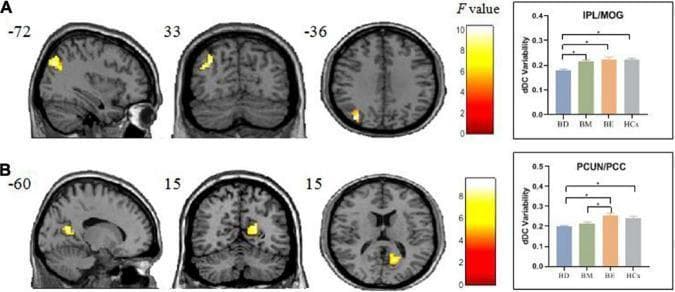 This composite diagnostic image presents statistical parametric maps and bar graphs demonstrating differences in dynamic degree centrality (dDC) variability in the brain among four clinical groups: bipolar depression (BD), bipolar mania (BM), bipolar euthymia (BE), and healthy controls (HCs). The content is organized into two panels (A and B).
Panel A displays sagittal, coronal, and axial views of the brain with heat-map clusters (yellow/red) in the left inferior parietal lobule and middle occipital gyrus (IPL/MOG). An adjacent bar graph shows significant decreases in dDC variability in the BD group compared to BM, BE, and HCs in this region.
Panel B displays similar brain views highlighting the right precuneus and posterior cingulate cortex (PCUN/PCC). The corresponding bar graph reveals that both BD and BM groups exhibit decreased dDC variability compared to the BE group.
Color bars indicate F-values ranging from 0 to 10. The image illustrates neuroimaging findings in bipolar disorder, highlighting abnormal intrinsic brain connectivity variability as a potential biomarker for different mood states.