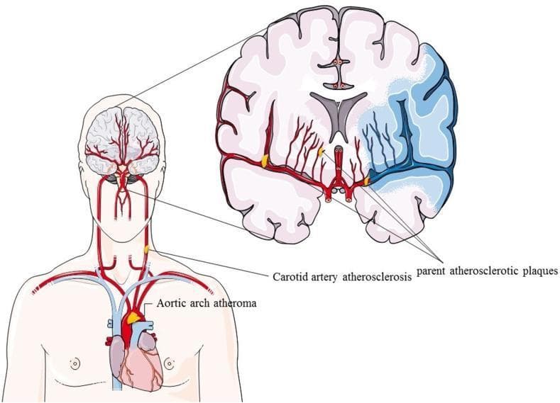 A medical illustration depicting the pathophysiological relationship between systemic atherosclerosis and ischemic stroke. The figure is divided into two primary views: a systemic vascular overview of the human torso and a detailed coronal section of the brain. The torso view displays the heart and great vessels, highlighting an 'Aortic arch atheroma' and 'Carotid artery atherosclerosis' with yellow plaques. The anatomical diagram shows the ascent of the carotid arteries toward the cerebral circulation. The enlarged coronal brain section illustrates a unilateral ischemic region, shaded in blue, representing a territory-specific stroke. 'Parent atherosclerotic plaques' are visualized at the origins of the cerebral arteries near the Circle of Willis. In the affected hemisphere, the distal vasculature appears dark and occluded compared to the healthy, red-colored branching vessels in the contralateral hemisphere. This diagram serves as an educational tool to demonstrate how proximal arterial plaques (aortic, carotid, and intracranial) contribute to distal cerebral infarction.