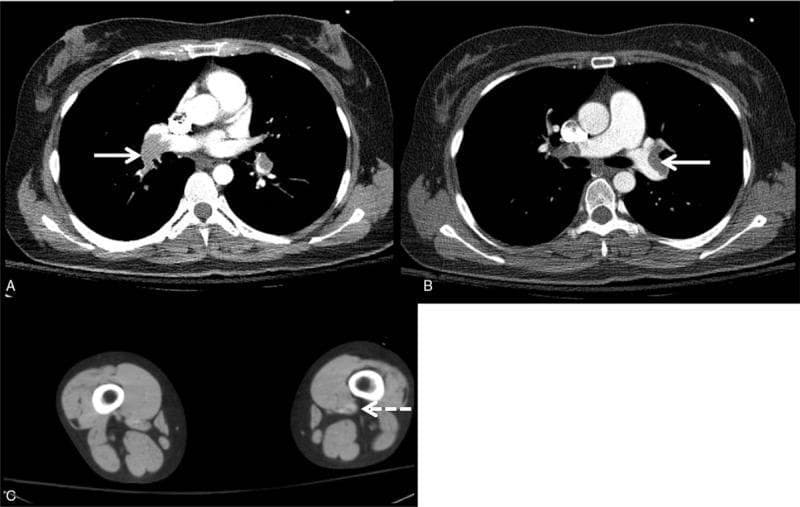 This composite diagnostic image features contrast-enhanced computed tomography (CT) scans illustrating a case of venous thromboembolism. Panels A and B are axial CT pulmonary angiogram (CTPA) slices of the thorax, demonstrating significant filling defects within the right and left main pulmonary arteries (indicated by solid white arrows), as well as within the lobar branches. These hypodense areas within the contrast-opacified vascular lumen are pathognomonic for acute pulmonary embolism. Panel C is an axial CT scan of the lower extremities at the level of the thighs/popliteal fossa, showing a filling defect in the left popliteal vein (indicated by a dashed white arrow), consistent with deep vein thrombosis (DVT). The educational focus of the image is to demonstrate the radiological correlation between a proximal DVT and resultant massive pulmonary thromboembolism. This material is relevant for medical students and radiology residents studying cardiovascular pathology and emergency diagnostic imaging.
