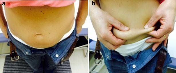 This clinical photograph displays a side-by-side comparison of insulin-induced lipohypertrophy on the abdominal wall of a patient with diabetes. Panel (a) illustrates the macroscopic appearance of the abdomen, showing moderate, generalized swelling and a rounded contour below the umbilicus, consistent with a localized accumulation of subcutaneous fat ('skin plate') at a frequent insulin injection site. Panel (b) demonstrates the clinical 'pinch test' for diagnostic assessment. The left side shows a significantly thicker, denser fold of tissue when the lipohypertrophic area is squeezed, while the contralateral side, where injections are avoided, results in a normal, markedly thinner skin fold. These visual findings emphasize the importance of injection site rotation to prevent abnormal adipose tissue proliferation. The images serve as an educational tool for healthcare professionals and patients to identify lipohypertrophy through inspection and palpation, highlighting the morphological differences between pathological and healthy subcutaneous tissue.