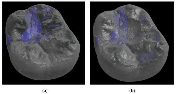 This diagnostic image consists of two reconstructed 3D micro-computed tomography (µCT) scans of a human molar tooth restoration, demonstrating mechanical wear and abrasion. The scans compare the tooth at baseline (a) and after a chewing simulation of 1,200,000 cycles (b). The images utilize a grayscale rendering for the tooth anatomy and dental restorative material, with blue color-coding identifying specific regions of interest or material surface irregularities. In image (a), the occlusal surface exhibits intact morphology with defined cusps and a relatively smooth central fissure. In image (b), significant occlusal wear is visible, characterized by a distinct central depression, loss of material volume, and blunting of the cuspal anatomy. The blue highlighted regions show an altered distribution post-simulation, indicating changes in surface texture and exposure of deeper material layers due to cyclic loading. This comparison is used in dental materials science to quantitatively assess the wear resistance and volumetric stability of restorative materials like DeltaFil.