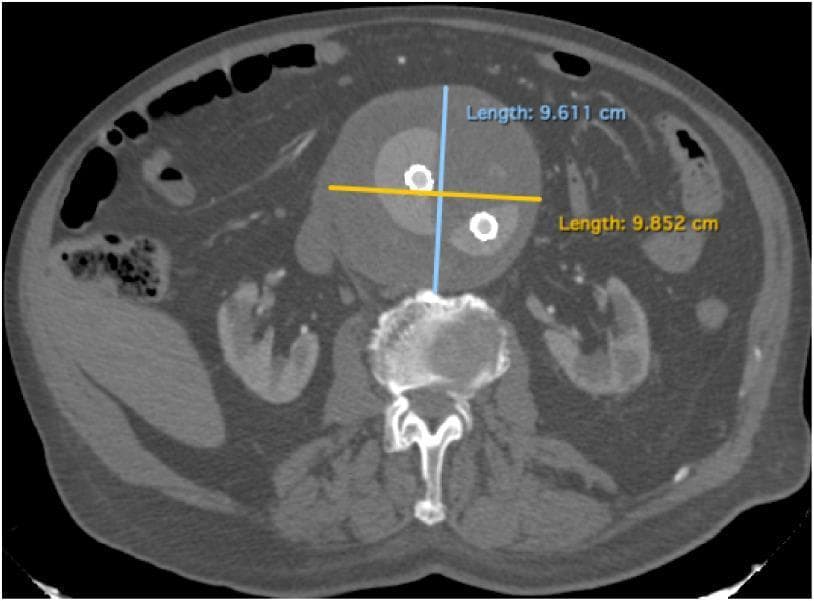 This axial computed tomography (CT) scan of the abdomen demonstrates a voluminous infrarenal abdominal aortic aneurysm (AAA). The image highlights a large, circular aneurysmal sac located anterior to the lumbar vertebral body. The sac is annotated with two perpendicular measurement calipers, indicating a transverse diameter of 9.852 cm and an anteroposterior diameter of 9.611 cm. Within the lumen of the aneurysm, two hyperdense circular foci are visible, consistent with endovascular aneurysm sealing (EVAS) devices or stent-graft components surrounded by endobags. The surrounding anatomy includes the vertebral column posteriorly, and the bilateral kidneys situated laterally to the aneurysm. The scan provides clinical evidence of aneurysm expansion during post-operative follow-up, suggesting potential complications such as a type Ia endoleak. This image serves as a diagnostic tool for monitoring stent-graft stability and sac morphology in patients treated for complex vascular pathologies.
