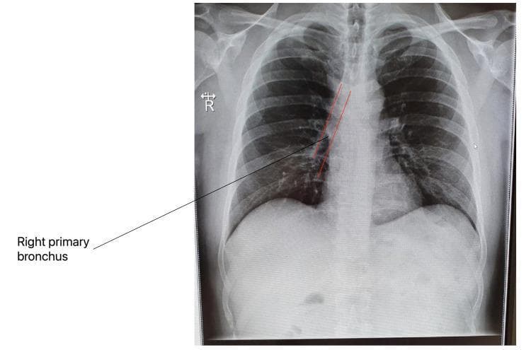 This diagnostic image is a posteroanterior (PA) chest X-ray illustrating normal thoracic anatomy. The radiographic view displays a clear tracheobronchial tree, with specific red line annotations and a pointer identifying the right primary bronchus as it descends from the carina into the right lung hilum. The lung parenchyma appears radiolucent and bilaterally symmetrical without evidence of consolidations, masses, or pleural effusions. Key anatomical landmarks visible include the heart and mediastinal borders, the diaphragm with sharp costophrenic angles, and the bony structures of the rib cage, clavicles, and thoracic vertebrae. This visual serves as an educational baseline for clinical radiology, demonstrating the expected vertical orientation of the right mainstem bronchus relative to the left, which is significant in the study of foreign body aspiration and pulmonary infection pathways, such as those seen in COVID-19 progression.