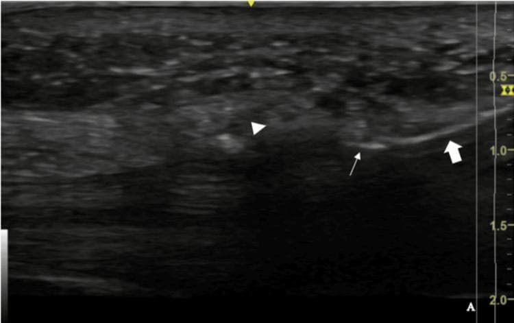 This diagnostic image is a sonographic long-axis view of the wrist, demonstrating a Sono-Instrument during a carpal tunnel release procedure. The cutting instrument (indicated by a thick white solid arrow) is positioned in the sagittal plane, making contact with the proximal portion of the transverse carpal ligament (TCL), which appears as a structure with intermediate echogenicity (marked by a white arrowhead). A distinctive hyperechoic line (noted by a thin white arrow) is visible at the distal tip of the instrument. This highly reflective linear feature corresponds to ultrasound wave reflection over a specialized flange on the blade, serving as a critical visual marker to identify the exact cutting edge of the instrument in real-time. The image illustrates the ultrasound-guided surgical technique for safely releasing the TCL while maintaining precise spatial awareness of the surgical tool relative to the wrist anatomy. This clinical visualization is essential for orthopedic surgeons and radiologists focusing on minimally invasive treatment of carpal tunnel syndrome.
