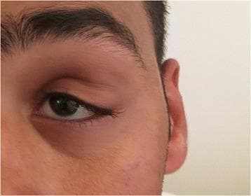 This clinical photograph shows the left periocular region of a patient, demonstrating significant soft tissue swelling at the superolateral angle of the left orbit. The mass is located in the anatomic region of the lacrimal gland, presenting as a visible fullness that distends the overlying skin. Associated clinical findings include a mechanical ptosis of the left upper eyelid, resulting in a narrowed palpebral fissure. The skin overlying the swelling appears slightly erythematous or discolored compared to the surrounding facial tissue. There is no evidence of significant proptosis or globe displacement visible from this frontal-oblique view. This clinical presentation is typical for orbital adnexal lesions, such as a lacrimal gland tumor or inflammatory myofibroblastic tumor (IMT). The image serves as an educational example of orbital mass localization and its secondary effects on eyelid positioning.