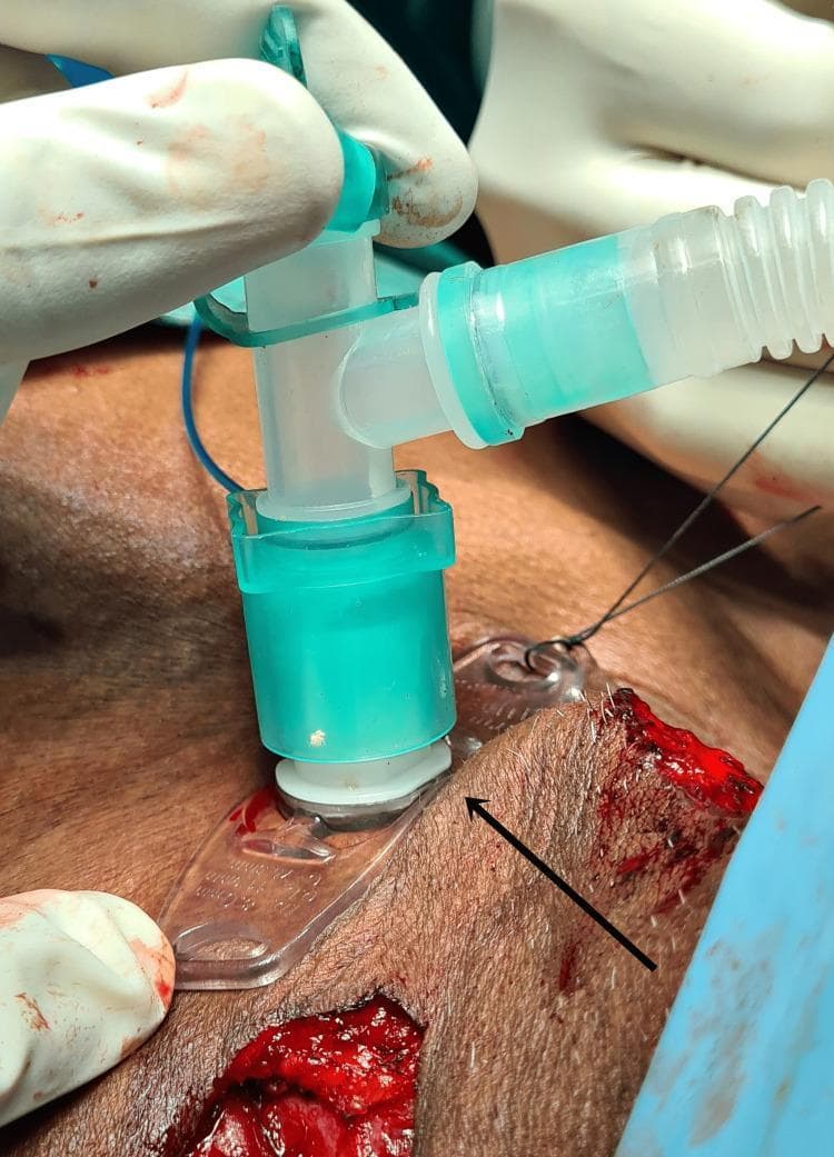 This clinical photograph captures an intraoperative tracheostomy procedure in a human patient. The central focus is an 8.0 mm cuffed tracheal tube apparatus inserted into a surgical stoma in the anterior neck. The apparatus features a white tracheostomy flange resting against the skin, secured by a clear plastic holder and stabilization sutures. Connected to the tube is a green-tinted T-piece adapter, which is attached to a semi-transparent, corrugated teal breathing circuit. A fine blue pilot balloon line for cuff inflation is also visible. The surgical site shows fresh incisions with exposed subcutaneous tissue and minor bleeding, consistent with an active operative environment. Gloved hands are seen stabilizing the equipment. This image serves as a clinical reference for airway management during complex head and neck oncological surgeries, illustrating the positioning and securing of a tracheostomy tube in a surgical setting.