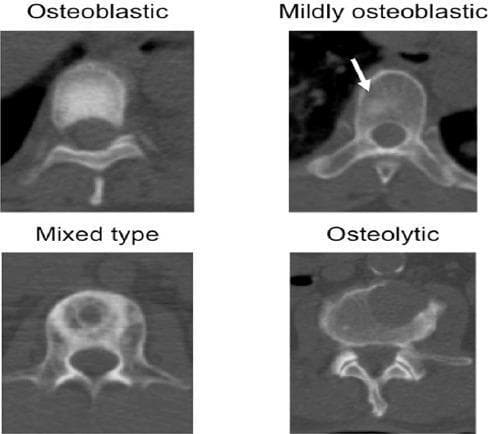 This diagnostic image consists of four axial Computed Tomography (CT) scans of vertebral bodies, illustrating the radiological spectrum of bone metastasis. The image is a comparison chart categorized by lesion morphology: osteoblastic, mildly osteoblastic, mixed type, and osteolytic. The 'Osteoblastic' panel shows a diffuse, homogeneous increase in bone density (sclerosis) within the vertebral body. The 'Mildly osteoblastic' panel, indicated by a white arrow, demonstrates a subtle focal area of increased radiodensity compared to normal trabecular bone. The 'Mixed type' panel displays a combination of sclerotic (hyperdense) and lytic (hypodense) regions, representing concurrent bone formation and destruction. The 'Osteolytic' panel exhibits significant cortical and medullary bone loss, characterized by a well-defined hypodense area and compromised structural integrity. These images serve as an educational reference for oncologic imaging, specifically for classifying metastatic bone disease and understanding how different primary cancers may alter bone remodeling.