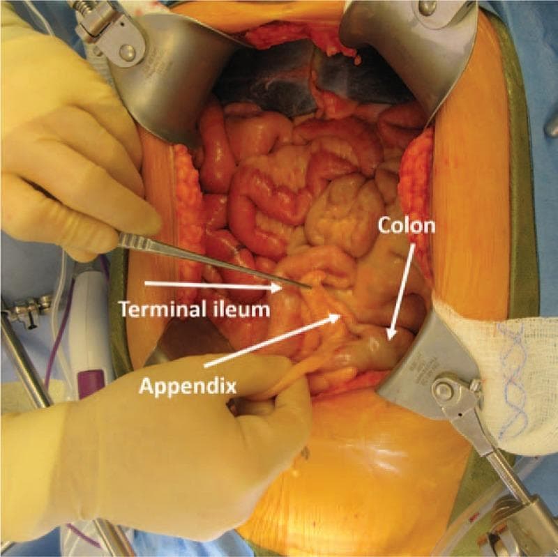 This intraoperative clinical photograph displays an open abdominal surgical field during an exploratory laparotomy. The image provides a visual demonstration of midgut nonrotation, a component of heterotaxy syndrome. Anatomical structures are labeled with white arrows and text: the appendix and terminal ileum are atypically located in the left lower quadrant, while the colon is positioned within the pelvis. A surgeon's gloved hands are visible using forceps and manual retraction to isolate the appendix for identification. Large metal retractors maintain the surgical incision. The bowel segments appear healthy with a glistening, moist serosal surface and reddish-pink vascularization, showing no signs of acute inflammation or ischemia. This educational image illustrates abnormal embryologic development where midgut structures failed to complete the standard 270-degree counterclockwise rotation, resulting in the reversed spatial arrangement of the cecal-appendiceal complex and small intestine. The photograph is highly relevant for surgical training and embryology education regarding congenital visceral anomalies.