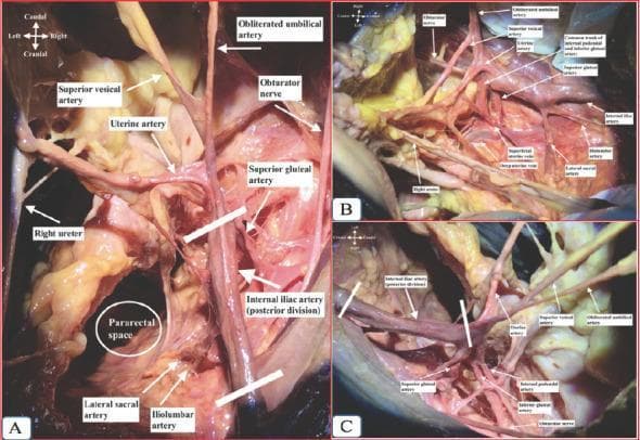 This surgical clinical photograph series illustrates the detailed anatomy of the right internal iliac artery and its branches through three perspectives: superior (A), medial (B), and lateral (C) views. The dissection highlights the pelvic vasculature essential for gynecological and pelvic surgery. Key arterial structures shown include the posterior division of the internal iliac artery giving rise to the superior gluteal, iliolumbar, and lateral sacral arteries. The anterior division branches are clearly visible, including the uterine artery, superior vesical artery, and the obliterated umbilical artery. Also demonstrated are the obturator nerve, the right ureter, and the pararectal space. View B specifically identifies venous components like the superficial and deep uterine veins, and the common trunk of the internal pudendal and inferior gluteal arteries. This educational material is intended for advanced medical students and surgical residents to understand the complex spatial relationships within the female pelvis, emphasizing vascular preservation and identification during retroperitoneal dissection.