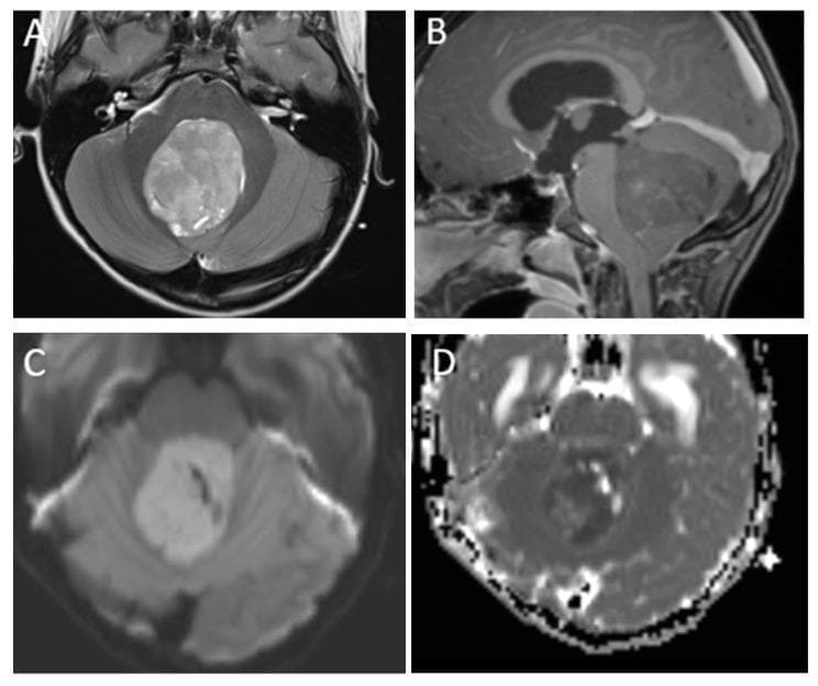 This multi-modal MRI panel presents characteristic findings of medulloblastoma in a 7-year-old child. Image (A), an axial T2-weighted sequence, reveals a large, mildly heterogeneous, hyperintense midline mass within the posterior fossa, exerting mass effect and compressing the fourth ventricle. Image (B), a sagittal post-contrast T1-weighted image, shows the solid mass occupying the cerebellar vermis with heterogeneous enhancement. Advanced sequences include Diffusion-Weighted Imaging (C) and an Apparent Diffusion Coefficient (ADC) map (D). The lesion exhibits marked diffusion restriction, visualized as high signal on DWI and corresponding low signal on ADC. This restriction is a hallmark of highly cellular embryonal neoplasms, such as WHO Grade 4 medulloblastomas. The images provide critical diagnostic information for pediatric neuro-oncology, highlighting the importance of assessing tumor location, morphology, and cellularity through multi-parametric magnetic resonance imaging to differentiate medulloblastoma from other posterior fossa tumors like ependymoma or pilocytic astrocytoma.