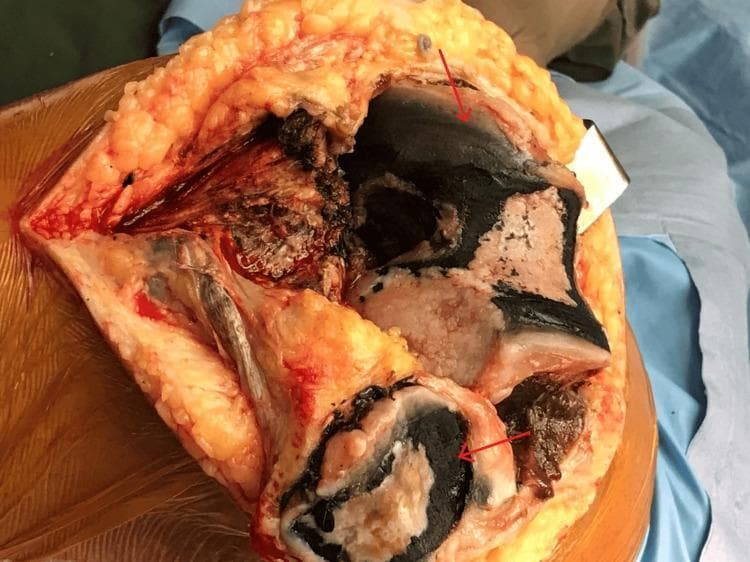 This clinical photograph captures an intraoperative view of an exposed left knee joint during a total knee arthroplasty. The image displays a significant and distinctive pathological finding: extensive blackish-to-inky pigmentation (ochronosis) covering the articular bone surfaces. Red arrows highlight the dense, charcoal-colored deposits concentrated on the femoral condyles and tibial plateau. The surrounding tissues include yellowish subcutaneous adipose tissue, reddish muscle fibers, and white-to-tan bone surfaces where the pigment is less dense. The pigmentation appears as irregular, granular patches and streaks that adhere closely to the articular cartilage and subchondral bone. This visual finding is characteristic of Alkaptonuria, a rare metabolic disorder where homogentisic acid accumulation leads to systemic connective tissue discoloration (ochronosis). The image serves as a clinical specimen example of advanced ochronotic arthropathy within an orthopedic surgical context.
