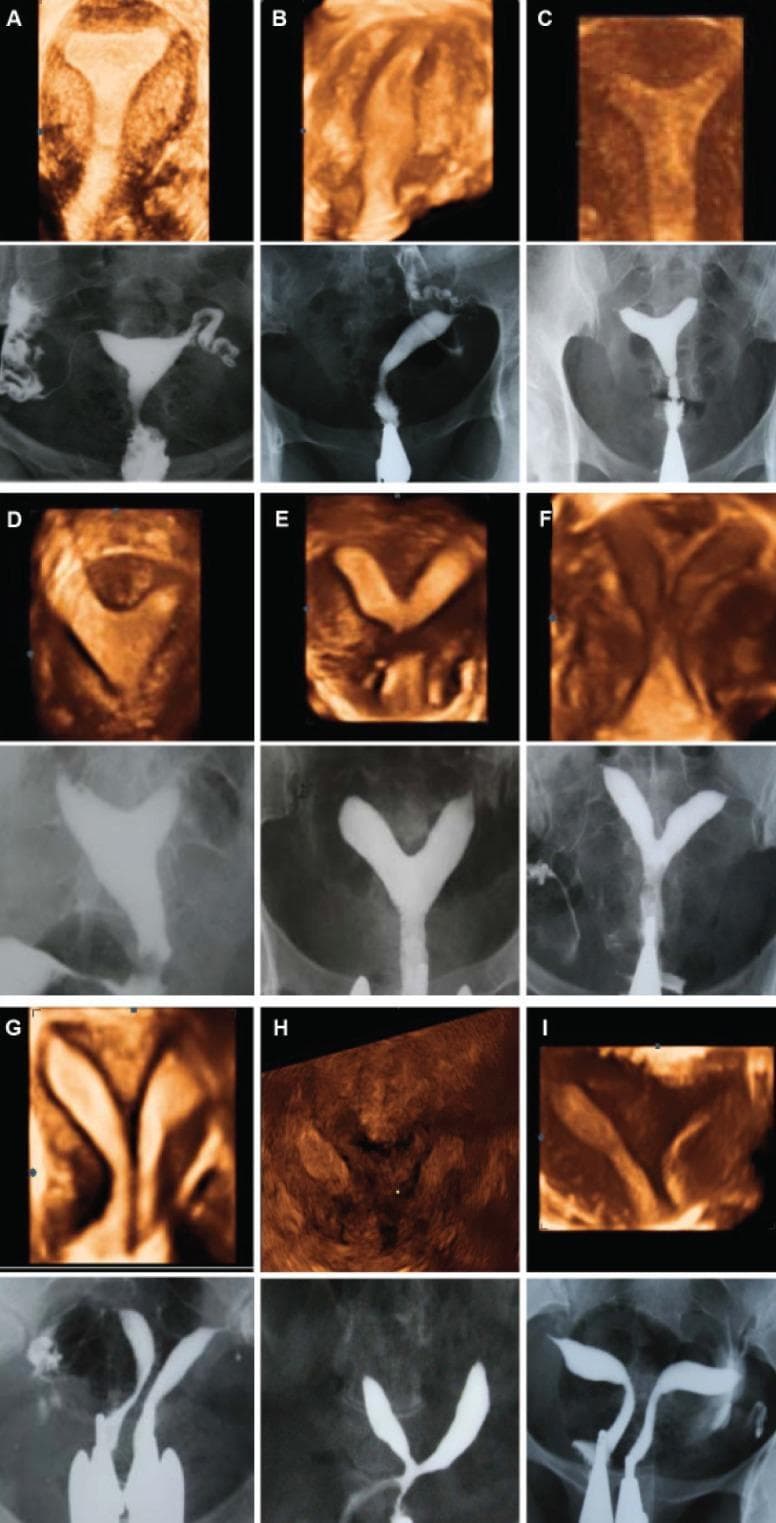 This composite educational graphic provides a side-by-side comparison of 3D ultrasound (coronal view) and Hysterosalpingography (HSG) imaging for the classification of Mullerian Duct Anomalies (MDAs) according to American Fertility Society (AFS) criteria. The panel features nine clinical cases (A-I), each illustrating a specific uterine morphology. (A) Normal uterus with a convex fundal contour and triangular cavity. (B) Unicornuate uterus demonstrating a single uterine horn and fallopian tube. (C) Arcuate uterus characterized by a mild fundal indentation. (D-G) Subtypes of septate uterus, ranging from partial to complete septation, where the 3D ultrasound clarifies the external fundal contour (straight or convex) versus the internal division. (H) Bicornuate uterus showing a prominent external fundal cleft and two divergent horns. (I) Uterus didelphys displaying two completely separate uterine bodies. The dual-modality approach highlights how 3D ultrasound assesses both the external serosal contour and internal cavity, while HSG provides high-contrast visualization of the internal lumen and tubal patency.