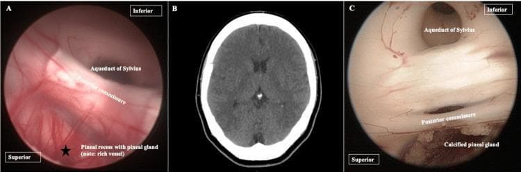 This composite educational graphic illustrates the anatomy and pathology of the pineal gland through a comparison of radiological and neuroendoscopic modalities. Panel A presents a neuroendoscopic view of the posterior third ventricle, highlighting the pineal recess (marked with a star), the posterior commissure, and the Aqueduct of Sylvius. This view emphasizes the rich vascularity of the pineal region. Panel B is a non-contrast axial CT scan of the brain, demonstrating a physiological hyperdense calcification of the pineal gland (circled) located at the midline. Panel C provides a corresponding neuroendoscopic view of a calcified pineal gland (corpora arenacea), showing a distinct 'brain sand' or granular texture below the posterior commissure and Aqueduct of Sylvius. This comparison illustrates how physiological calcifications, commonly seen as hyperdensities on diagnostic CT imaging, appear as physical anatomical features during neurosurgical procedures. The content is suitable for neurosurgical training and advanced anatomical studies focusing on the ventricular system and pineal region pathology.