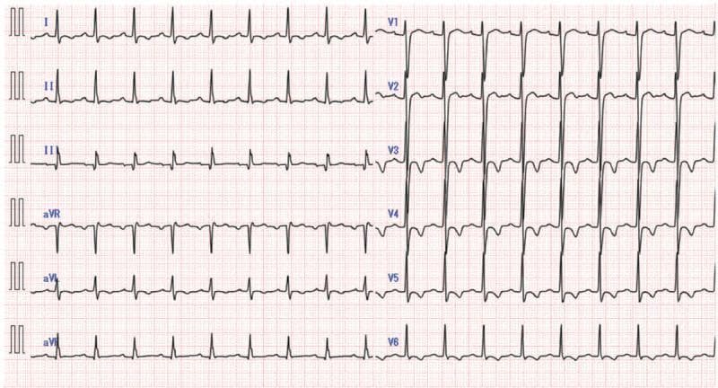A standard 12-lead electrocardiogram (ECG) displayed on a grid of small (1mm) and large (5mm) squares. The tracing shows a normal sinus rhythm with a heart rate of approximately 75 beats per minute. Each QRS complex is preceded by a consistent P wave with a normal PR interval. The QRS complexes are narrow (<120 ms), and there is a normal R-wave progression in the precordial leads (V1-V6). The QTc interval is within the normal range (measured at 429 ms), indicating a resolution of prior prolongation. The limb leads (I, II, III, aVR, aVL, aVF) demonstrate a normal axis, with predominantly upright complexes in leads I and II. There are no signs of ST-segment elevation, ST-segment depression, or pathological Q waves. This ECG represents a stable electrophysiological state following the resolution of tricyclic antidepressant (TCA)-induced cardiotoxicity and tachyarrhythmias.