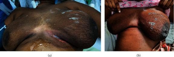 This clinical photograph consists of two panels illustrating gross pathological findings in the breasts. Panel (a) provides a comparative view of both breasts, demonstrating significant asymmetry; the left breast is markedly enlarged and swollen relative to the right. Panel (b) offers a close-up perspective of the left breast, highlighting diffuse erythema (redness) and skin changes consistent with inflammation. A distinct discharging sinus is visible in the medial quadrant, located just medial to the left nipple-areolar complex. The surrounding skin exhibits a thickened, edematous texture, occasionally referred to as peau d'orange appearance in such clinical contexts. These visual signs—swelling, redness, and a draining sinus tract—are characteristic markers of a severe inflammatory process, such as inflammatory breast cancer, complicated mastitis, or a ruptured mammary abscess. The image serves as an educational tool for recognizing clinical signs of advanced breast pathology and associated cutaneous manifestations.