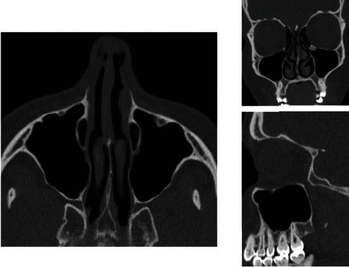 This diagnostic image set consists of three non-contrast Computed Tomography (CT) scans of the midface and paranasal sinuses, presented in axial, coronal, and sagittal planes. The axial view (left) displays the bilateral maxillary sinuses as large, air-filled (radiolucent) cavities lateral to the nasal cavity and posterior to the maxilla. The coronal view (top right) highlights the vertical relationship between the orbits superiorly, the nasal conchae centrally, and the maxillary sinuses. Inferiorly, the relationship between the sinus floor and the alveolar process is visible. The sagittal view (bottom right) provides a detailed cross-section of the maxilla, specifically illustrating the anatomical proximity of the maxillary molar and premolar tooth roots to the inferior cortical wall (floor) of the maxillary sinus. This anatomical relationship is critical for understanding risks of iatrogenic sinus effraction or oroantral communication during dental extractions. The images serve as an educational reference for normal sinus anatomy and the evaluation of the sinus floor thickness in relation to the dental apparatus.