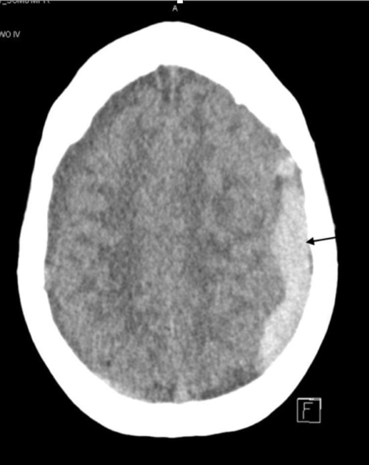 This diagnostic image is a non-contrast axial computed tomography (CT) scan of the brain. The primary finding is a large, hyperdense, crescent-shaped collection along the left cerebral convexity, characteristic of an acute subdural hematoma (SDH). The hematoma is well-demarcated and follows the contour of the inner table of the skull, extending across the frontoparietal region. There is a visible mass effect on the underlying brain parenchyma, evidenced by effacement of the adjacent sulci and a shift of midline structures toward the right side. The high attenuation (brightness) of the collection relative to the brain tissue is consistent with acute extravasation of blood. This scan illustrates a common neurosurgical emergency often associated with head trauma or anticoagulation therapy, demonstrating the visual hallmarks used to differentiate a subdural hematoma from the lenticular shape of an epidural hematoma.
