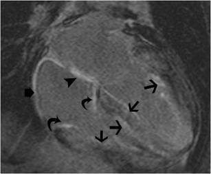 This diagnostic cardiac MRI is a four-chamber delayed-enhancement (LGE) view demonstrating characteristic findings of cardiac amyloidosis. The image shows a diffuse and global pattern of hyperenhancement involving multiple cardiac structures. Notable features include intense late gadolinium enhancement of the tricuspid valve leaflets (curved arrows) and the interatrial septum (arrowhead). Furthermore, there is diffuse, transmural hyperenhancement of both the left and right ventricular myocardium (straight arrows), alongside visible enhancement of the right atrial wall (short arrow). These findings indicate an extensive interstitial deposition of amyloid proteins throughout the heart, characteristic of restrictive cardiomyopathy. The image highlights the systemic nature of amyloid infiltration, affecting not only the ventricular and atrial myocardium but also the valvular apparatus and septal structures, which distinguishes it from regional ischemic patterns of enhancement.
