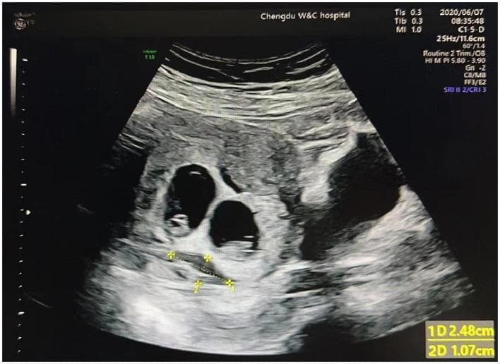 This diagnostic ultrasound image demonstrates a first-trimester dichorionic twin pregnancy. Two distinct, anechoic (fluid-filled) gestational sacs are visible within the uterus, each surrounded by a hyperechoic decidual reaction. Within each sac, a small hyperechoic structure consistent with a yolk sac is identifiable. Adjacent to the gestational sacs, there is a crescent-shaped area of mixed echogenicity representing a subchorionic hematoma (SCH), which is an accumulation of blood behind the chorionic membrane. Electronic calipers are used to measure the SCH, indicating a length (1D) of 2.48 cm and a width (2D) of 1.07 cm. The image was captured using a curvilinear transducer (C1-5-D) at a scan depth of 11.6 cm. This clinical image is illustrative for obstetrics and gynecology students and clinicians studying the diagnosis and monitoring of subchorionic hemorrhage in multiple gestations.