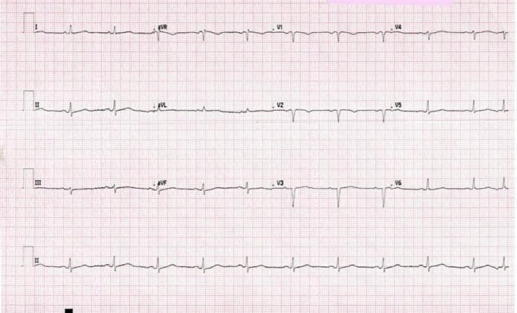 A standard 12-lead electrocardiogram (ECG) displayed on a pink grid. The tracing demonstrates a sinus rhythm with several diagnostic abnormalities. In the precordial leads (V1-V6), there is evidence of poor R-wave progression, characterized by low-amplitude R waves that fail to increase appropriately across the chest leads. Pathological Q-waves are present in the anterior and lateral leads (V1 through V6), suggesting a prior anterolateral myocardial infarction or significant underlying cardiomyopathy. The voltage across the leads is generally low. Morphological changes in the P-waves are visible, specifically a biphasic P-wave in lead II and a prominent negative terminal deflection of the P-wave in lead V1, which are classic indicators of left atrial enlargement (P mitrale). A premature atrial contraction (PAC) is also observable in the rhythm strip. This diagnostic image is intended for medical students and clinicians to recognize patterns of atrial enlargement, poor R-wave progression, and low-voltage ECG readings in the context of cardiovascular pathology.