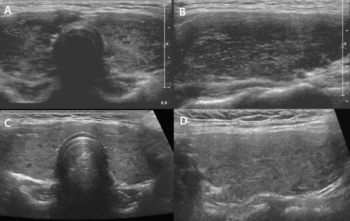 Diagnostic ultrasound images of the thyroid gland in a 14-year-old female patient, demonstrating longitudinal and transverse planes across two time points. Panel A (transverse) and B (longitudinal) represent the initial assessment, showing an enlarged thyroid with Grade 4 (G4) changes characterized by marked hypoechogenicity and diffuse heterogeneity compared to the anterior strap muscles. The parenchyma appears coarse with irregular, low-echo areas. Panels C (transverse) and D (longitudinal) show a follow-up ultrasound one year later. These images demonstrate improvement to Grade 3 (G3), where the thyroid exhibits reduced heterogeneity and improved echogenicity (becoming more isoechoic to the strap muscles) with a smoother, more uniform parenchymal texture. The study illustrates the radiological progression and correlation between ultrasound grading of autoimmune thyroid disease (such as Hashimoto's thyroiditis or Graves' disease) and clinical thyroid function improvement from overt hypothyroidism to euthyroidism.