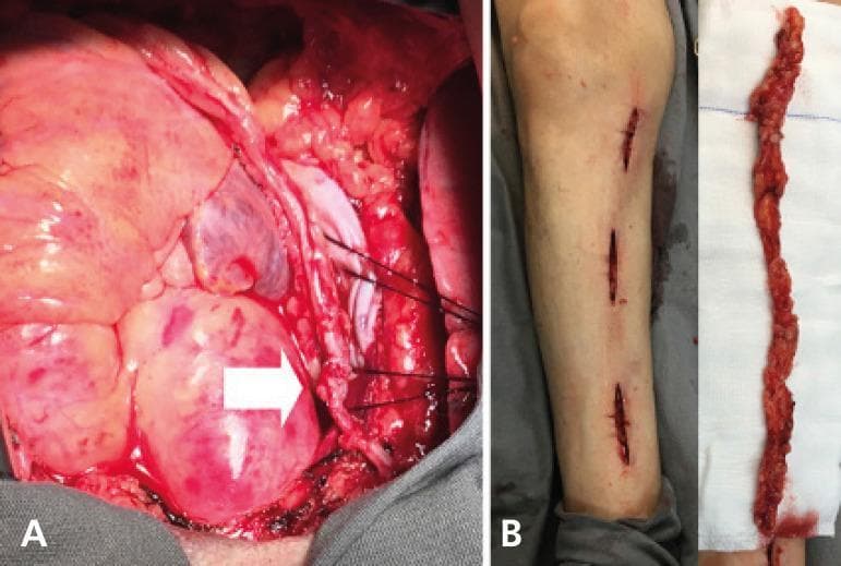 This composite clinical photograph illustrates key stages of a coronary artery bypass graft (CABG) surgery using a 'no-touch' saphenous vein (SV) harvesting technique. Panel A presents an intraoperative view of the surgical field during an off-pump coronary artery bypass (OPCAB). It shows a saphenous vein graft anastomosed to the posterior descending coronary artery, with a proximal connection to the right internal thoracic artery (RITA) stump, indicated by a white arrow. The vessels are secured with sutures, and the surrounding cardiac tissue and epicardial fat are visible. Panel B displays the donor site and the harvested conduit. The left side of the panel shows the lower extremity with three small, longitudinal incisions, characteristic of a minimally invasive, skin-bridging harvesting approach. The right side shows the harvested saphenous vein lying on a surgical gauze. The conduit is notable for its 'no-touch' appearance, characterized by an intact pedicle of perivascular adipose and connective tissue, which preserves the vessel's endothelial integrity and natural architecture by avoiding manual dilation or stripping.