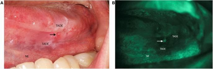 This dual-panel clinical photograph demonstrates oral squamous cell carcinoma screening using conventional white light and VELscope® tissue autofluorescence imaging. Panel A is a clinical photograph of the left lateral border of the tongue showing an indurated, erythematous ulcerated lesion (marked by an arrow) consistent with biopsy-proven squamous cell carcinoma. The surrounding area is labeled as Tumor Adjacent Dysplastic Epithelium (TADE), which appears clinically suspicious, while the more distal tissue is labeled as Normal Epithelium (NE). Panel B illustrates the same anatomical region under VELscope® examination. The malignant ulcer and the surrounding TADE exhibit significant fluorescence visualization loss (appearing as dark, non-fluorescent patches), whereas the NE maintains normal pale green autofluorescence. This comparison highlights the clinical utility of autofluorescence imaging in delineating surgical margins and identifying dysplastic changes that may not be fully apparent under standard illumination. The image serves as an educational tool for oral oncology, pathology, and diagnostic screening techniques.