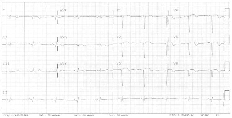 A standard 12-lead electrocardiogram (ECG) displayed in a 3x4 layout plus a rhythm strip, demonstrating a patient in normal sinus rhythm with significant pathological findings. The tracing reveals deep, pathological Q waves and poor R-wave progression across the precordial leads (V1 to V4), indicative of transmural myocardial necrosis. Associated ST-segment elevation and T-wave inversion are observed in the anterior-lateral leads (V1-V6), suggesting an ongoing or recent myocardial injury/infarct pattern. These findings are clinically significant for identifying a localized area of scarring and active ischemia in the anterior-lateral left ventricular wall. The modality is a diagnostic ECG on standard grid paper (25 mm/sec, 10 mm/mV), which is a critical tool for medical students and clinicians in identifying ischemic heart disease and localizing myocardial infarction.