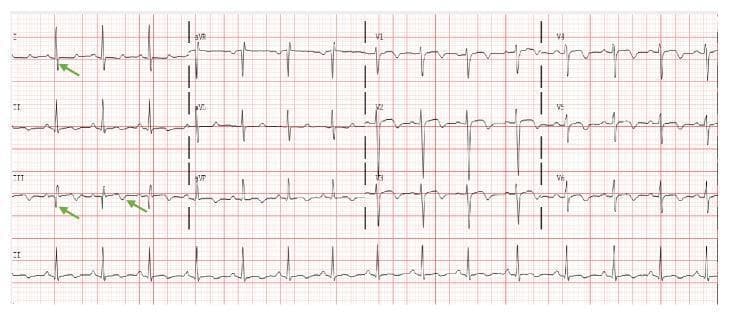 This diagnostic image is a 12-lead electrocardiogram (ECG) displayed on standard pink grid paper. The tracing shows a normal sinus rhythm with a heart rate of approximately 95 beats per minute. The primary educational focus is the classic S1Q3T3 sign, a sign of acute right ventricular strain often associated with pulmonary embolism. Key visual findings marked with green arrows include a deep S wave in Lead I, a prominent Q wave in Lead III, and an inverted T wave in Lead III. The QRS complex morphology is otherwise narrow with a normal axis. The chest leads (V1-V6) show normal R-wave progression. This visual material is used in medical education to teach the recognition of ECG manifestations of pulmonary hypertension and acute right-sided heart strain. Target audience includes medical students, residents, and emergency medicine practitioners.