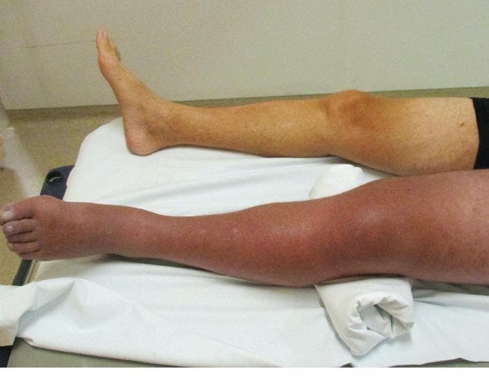 Clinical photograph providing a side-by-side comparison of a patient's lower extremities, illustrating the classic presentation of Phlegmasia Cerulea Dolens. The right leg displays a normal skin tone and anatomical contour. In contrast, the left leg exhibits significant pathology, characterized by diffuse, massive swelling (edema) extending from the thigh to the foot. The skin of the left leg shows deep erythematous and cyanotic discoloration, appearing smooth and taut, which is indicative of severe venous outflow obstruction and impending compartment syndrome. The left limb is slightly elevated on a bolster, while the patient is in a supine position. This image serves as a key diagnostic reference for identifying life-threatening deep vein thrombosis (DVT) complications, highlighting the hallmark triad of massive swelling, cyanosis, and pain (clinical context). It is intended for intermediate to advanced medical learners focusing on vascular surgery, emergency medicine, and hematology.
