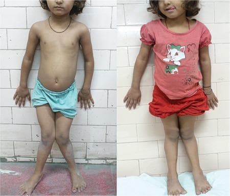 A comparison of two clinical photographs demonstrating the progression and partial resolution of genu valgum (knock-knees) in a pediatric patient. The left image shows a child with significant bilateral genu valgum; when the knees are adducted and touching, there is a wide intermalleolar distance between the ankles. The right image, taken after a 1-year follow-up following medical intervention (stosstherapy for nutritional rickets), shows a marked reduction in the angular deformity. The mechanical axis of the lower limbs appears more aligned, with a substantially narrower gap between the ankles when the knees are in proximity. These images illustrate the clinical manifestation of metabolic bone disease in children and the potential for lower limb remodeling with appropriate treatment. The visual focus is on the orthopedic alignment of the femurs and tibiae relative to the midline.