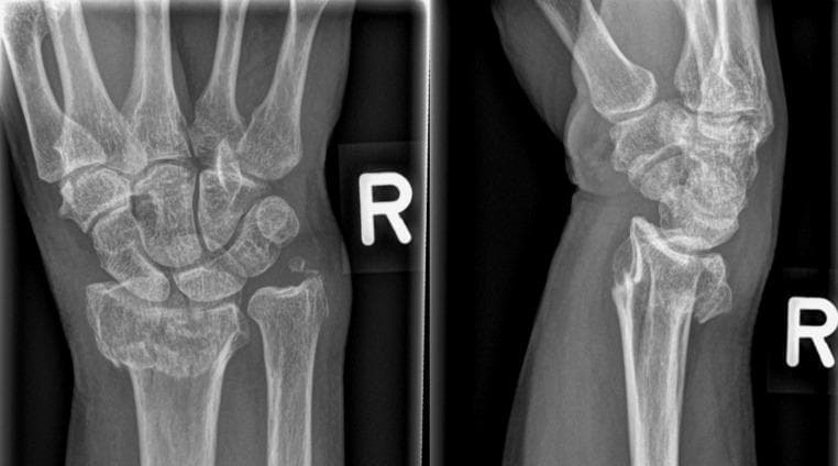 This diagnostic image consists of a two-view conventional radiograph (X-ray) of the right wrist, presenting both anteroposterior (AP) and lateral views. The image demonstrates a distal radius fracture with significant displacement. In the AP view (left), a transverse fracture line is visible across the distal metaphysis of the radius, accompanied by an associated fracture of the ulnar styloid process. The lateral view (right) clearly illustrates dorsal (posterior) displacement and dorsal angulation of the distal radial fragment, characteristic of a Colles-type fracture pattern. There is a disruption of the normal radiocarpal alignment, with the carpal bones following the dorsally displaced distal radius segment. Key anatomical structures visible include the distal radius and ulna, the proximal and distal carpal rows, and the bases of the metacarpals. This visual material is primarily used in orthopedic and emergency medicine education to teach fracture identification, terminology for displacement and angulation, and the assessment of wrist joint congruity.