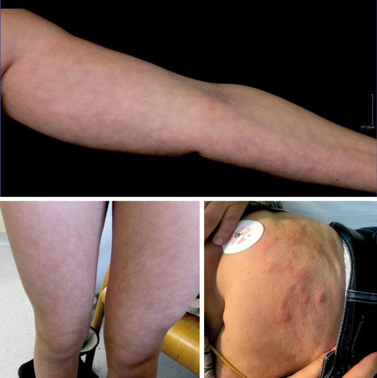 This composite of clinical photographs illustrates two distinct dermatological manifestations: livedo reticularis and urticaria. The top and bottom-left images display livedo reticularis on the arm and thighs, respectively. These images demonstrate a characteristic symmetric, mottled, and net-like (reticular) pattern of reddish-blue cyanotic discoloration. The pattern consists of closed rings or polygons, representing physiological or pathological changes in blood flow within the cutaneous vascular cones. The bottom-right image shows urticaria on the trunk, characterized by multiple raised, erythematous wheals and edematous plaques of varying sizes. Unlike the vascular mottling of livedo reticularis, these lesions are circumscribed, elevated, and represent localized dermal edema. These visuals serve as a comparative tool for differentiating vascular vasomotor changes from inflammatory skin reactions, which is clinically relevant in diagnosing conditions ranging from physiological cold response to systemic vascular disorders and allergic reactions.