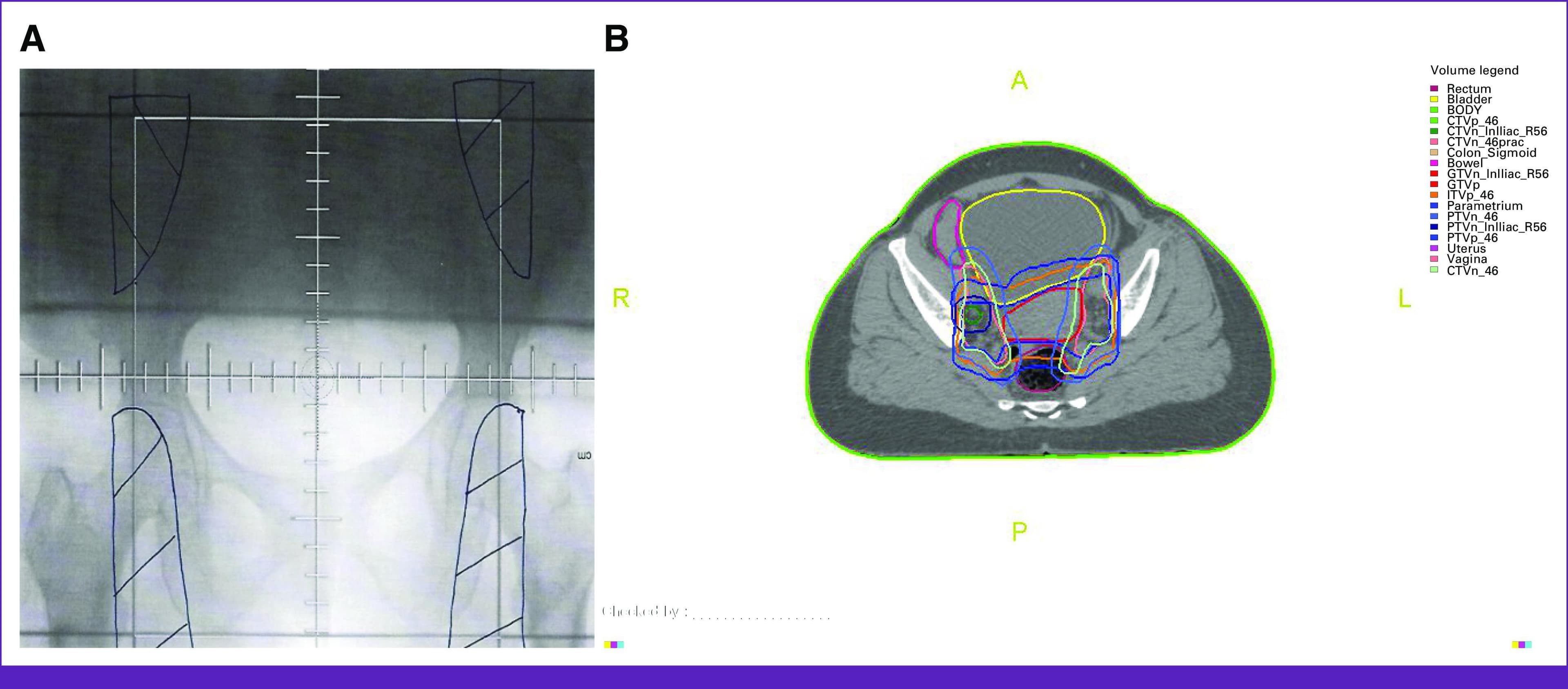 Educational comparison of radiotherapy planning techniques for cervical cancer, featuring conventional 2D external-beam radiotherapy (EBRT) and intensity-modulated radiotherapy (IMRT). Panel A displays a conventional simulator X-ray (anterior-posterior view) of the pelvis with radiation field borders delineated by black lines and a superimposed measurement grid for alignment based on bony landmarks. Panel B shows an axial CT slice through the pelvic region for IMRT planning. This panel demonstrates multi-color contouring of target volumes and organs at risk (OARs). Key delineated structures include the gross tumor volume (GTVp, red), primary clinical target volume (CTVp, light blue), and nodal targets (GTVn and CTVn, light/dark green). Anatomical OARs include the bladder (yellow, anterior), rectum (purple, posterior), uterus (dark blue), and vagina (light pink). The image illustrates the transition from basic field-shaping in 2D therapy to precise volumetric target delineation and OAR sparing in modern 3D/IMRT protocols.