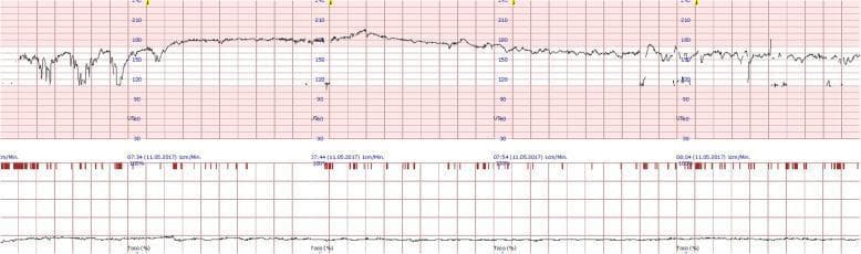 This diagnostic image shows a continuous fetal cardiotocography (CTG) tracing at 27 weeks of gestation, illustrating the impact and subsequent resolution of maternal diabetic ketoacidosis (DKA) on fetal well-being. The top panel displays the fetal heart rate (FHR) in beats per minute (bpm), while the bottom panel shows tocodynamometry (maternal uterine activity). The initial 30-minute segment (left side) demonstrates pathological features: a baseline tachycardia exceeding 160 bpm, significantly reduced baseline variability (flattened tracing), and repetitive variable decelerations characterized by sharp, transient drops in FHR. These findings are clinically significant as they reflect fetal stress or hypoxia secondary to maternal metabolic derangement. Following medical intervention (saline and insulin), the latter half of the tracing shows a clear normalization: the FHR baseline stabilizes around 150-160 bpm, normal beat-to-beat variability reappears, and decelerations resolve. This timeline-based progression serves as an educational example of how maternal acute illness affects fetal heart rate patterns and the rapid response to appropriate clinical stabilization.