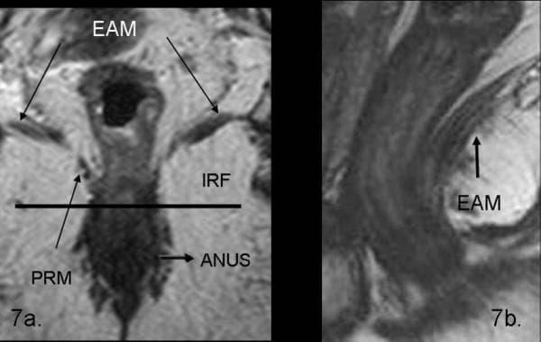 This diagnostic imaging set consists of two T2-weighted turbo spin-echo (TSE) MRI scans of the pelvic floor, demonstrating normal rectal and perianal anatomy. Image 7a is a coronal view illustrating the spatial relationship between the levator ani muscle (EAM), visible as a low-signal intensity band extending laterally and superiorly, and the puborectalis muscle (PRM) forming a muscular sling around the anal canal. The ischio-rectal fossa (IRF) is identified as a hyperintense region of fat lateral to the sphincter complex. The anal canal (ANUS) is shown in the midline. Image 7b is a sagittal view providing a longitudinal perspective of the levator ani muscle (EAM), appearing as a hypointense linear structure supporting the pelvic viscera. These images serve as an educational reference for identifying normal pelvic floor musculature, including the internal and external anal sphincters, and are critical for the staging and preoperative planning of rectal carcinomas and pelvic floor disorders.