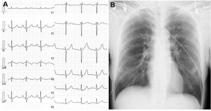 This composite clinical diagnostic image consists of two panels: (A) a standard twelve-lead electrocardiogram (ECG) and (B) a posterior-anterior (PA) view chest X-ray. The ECG demonstrates a normal sinus rhythm with a heart rate of approximately 75 beats per minute. Waveform analysis shows isoelectric ST segments and upright T waves across both limb leads (I, II, III, aVR, aVL, aVF) and precordial leads (V1-V6), with no acute signs of ST-segment elevation myocardial infarction (STEMI) or ischemia. The chest X-ray displays clear lung fields bilaterally with no evidence of consolidation, pleural effusion, or pulmonary vascular congestion. The heart silhouette is within normal limits with a documented cardiothoracic ratio of 42.0%. The mediastinum and hilar regions are unremarkable. Visible medical adjuncts on the radiograph include ECG lead wires and cutaneous electrodes on the chest wall. Together, these diagnostic visuals illustrate a typical initial cardiac evaluation where primary screening for ischemia and heart failure appears unremarkable.