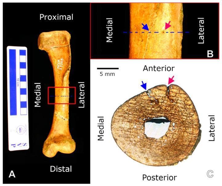 Educational panel illustrating the gross and microscopic anatomy of a left humerus. (A) Clinical photograph of the anterior view of the humerus, labeled with proximal, distal, medial, and lateral orientations. A 10 cm scale bar is included. A red box identifies the mid-diaphyseal region. (B) Close-up view of the mid-diaphyseal shaft showing a longitudinal crack (blue arrow) and a nutrient foramen (red arrow). A dotted blue line indicates the plane for histological sectioning. (C) Transverse thin section (histology) of the mid-diaphysis, oriented with anterior, posterior, medial, and lateral markers. A 5 mm scale bar is provided. The section reveals a thick cortical bone matrix surrounding a central, open medullary cavity. The microscopic view demonstrates primary and secondary bone tissue patterns, with the crack (blue arrow) and nutrient foramen (red arrow) visible on the anterior cortical margin. This material provides a comparison between external morphological landmarks and internal microstructural features, relevant for osteological and histological study.