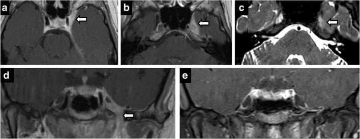 This composite of diagnostic images illustrates the radiological presentation and resolution of Tolosa-Hunt syndrome in a 23-year-old patient. The series includes axial T1-weighted contrast-enhanced (a, b), axial T2-weighted (c), and coronal contrast-enhanced (d) MRI scans. Arrows highlight abnormal, asymmetric enhancing soft tissue within the left cavernous sinus. This inflammatory tissue extends posteriorly into Meckel’s cave and inferiorly through the foramen ovale, indicative of the granulomatous inflammation characteristic of this condition. The coronal view (d) specifically demonstrates the extent of the enhancing phlegmon relative to the cranial nerve pathways. Frame (e) is a follow-up coronal contrast-enhanced T1 MRI showing complete resolution of the previously seen asymmetric enhancement and mass effect, demonstrating the typical rapid response of Tolosa-Hunt syndrome to corticosteroid therapy. This case serves as an educational example of painful ophthalmoplegia associated with non-specific inflammation of the cavernous sinus and its successful treatment progression.